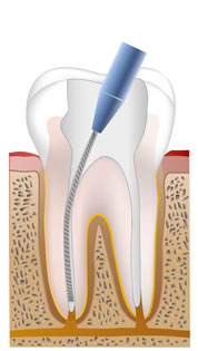 根管のメンテナンス