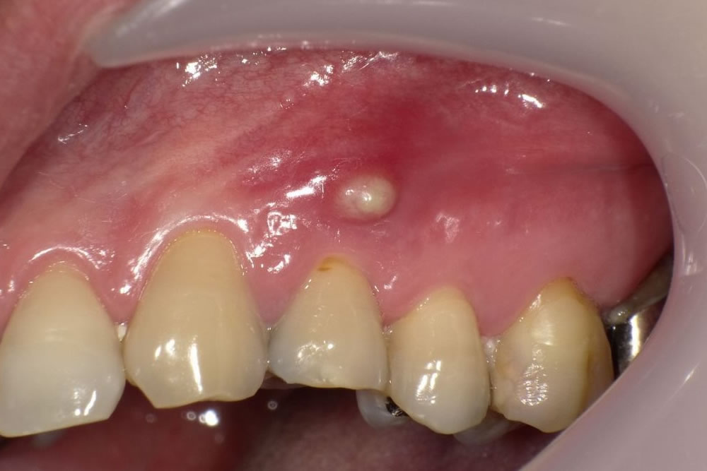 歯根破折による歯ぐきの腫れ