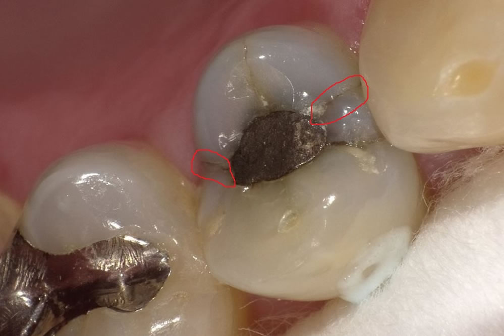 折 歯根 破 歯根破折保存治療について 意外と多い歯の根の破折