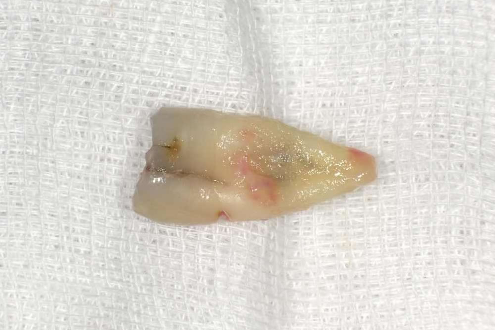 抜歯直後の歯