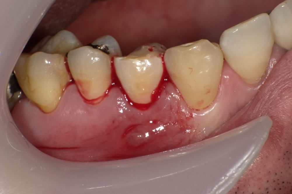 折れた歯の症状の管理