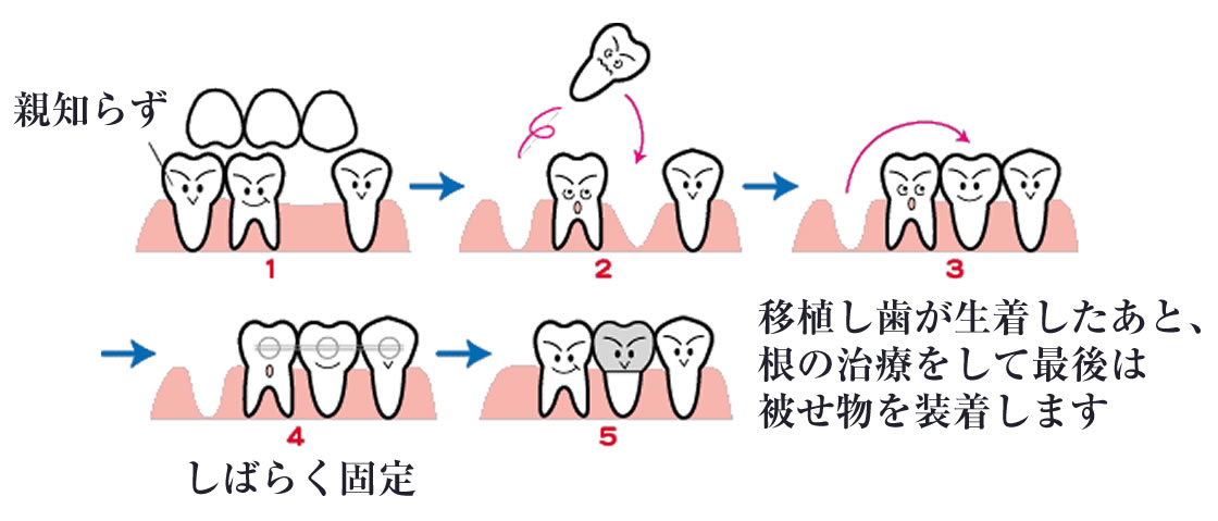 親知らずを残す理由